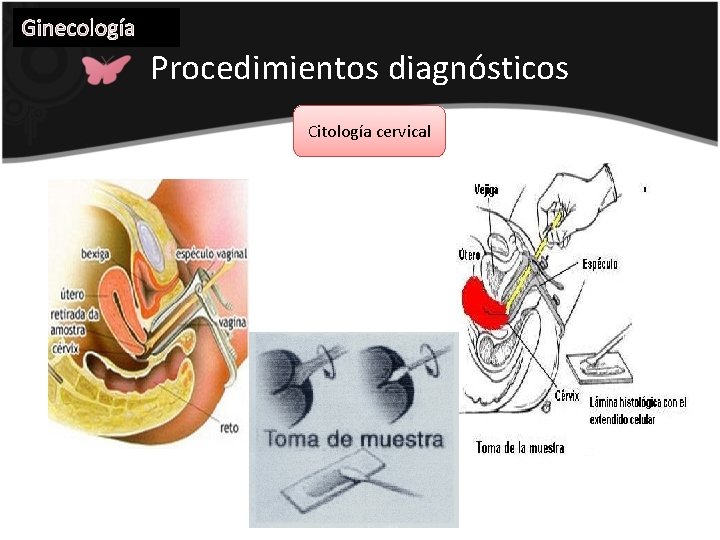 Ginecología Procedimientos diagnósticos Citología cervical 