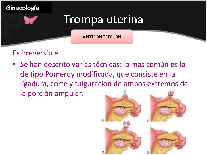 Ginecología Trompa uterina ANTICONCEPCION Es irreversible • Se han descrito varias técnicas: la mas