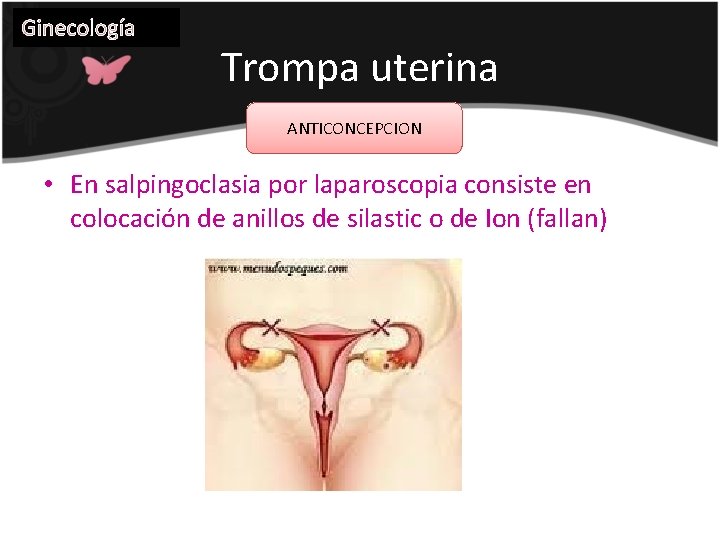 Ginecología Trompa uterina ANTICONCEPCION • En salpingoclasia por laparoscopia consiste en colocación de anillos
