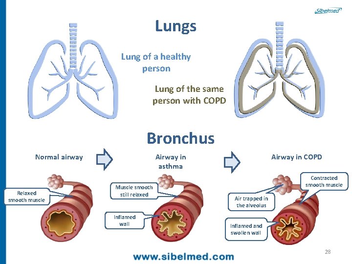 Lungs Lung of a healthy person Lung of the same person with COPD Bronchus