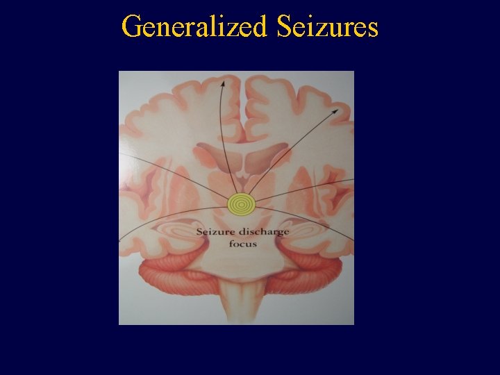 Generalized Seizures 