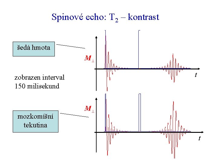 Spinové echo: T 2 – kontrast šedá hmota zobrazen interval 150 milisekund t mozkomíšní