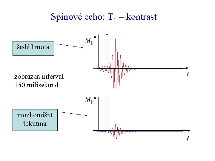 Spinové echo: T 1 – kontrast šedá hmota t zobrazen interval 150 milisekund mozkomíšní