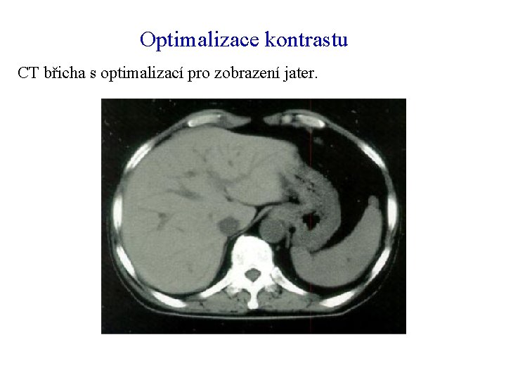 Optimalizace kontrastu CT břicha s optimalizací pro zobrazení jater. 