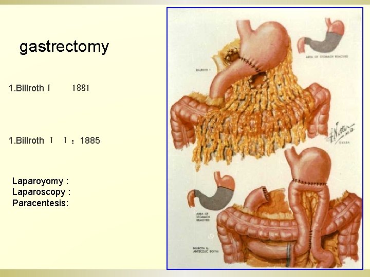 gastrectomy 1. BillrothⅠ 1881 1. Billroth Ⅰ Ⅰ ： 1885 Laparoyomy : Laparoscopy :