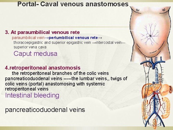 Portal- Caval venous anastomoses 3. At paraumbilical venous rete paraumbilical vein→periumbilical venous rete→ thoracoepigastric