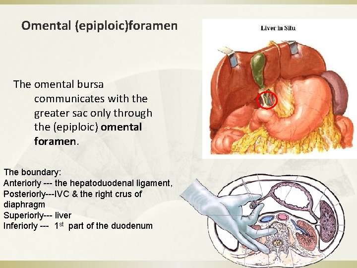 Omental (epiploic)foramen The omental bursa communicates with the greater sac only through the (epiploic)