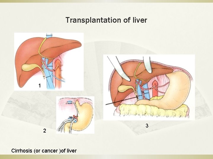 Transplantation of liver 1 2 Cirrhosis (or cancer )of liver 3 