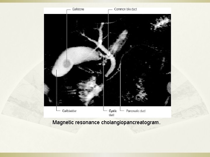 Magnetic resonance cholangiopancreatogram. 