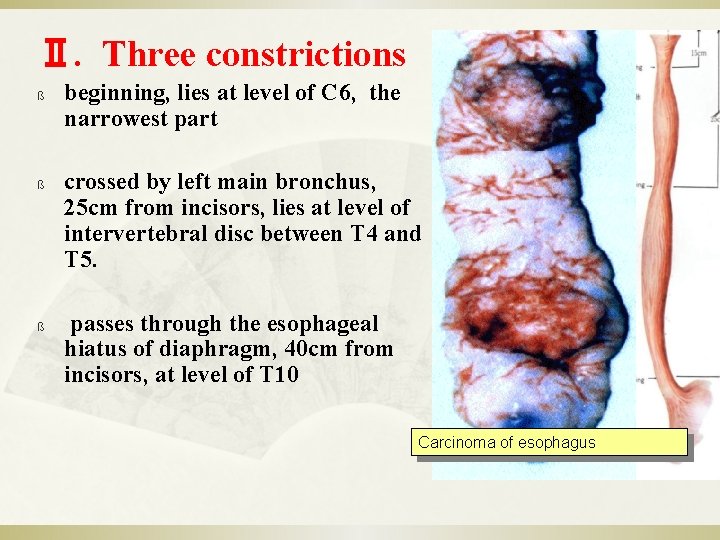 Ⅱ. Three constrictions ß ß ß beginning, lies at level of C 6, the