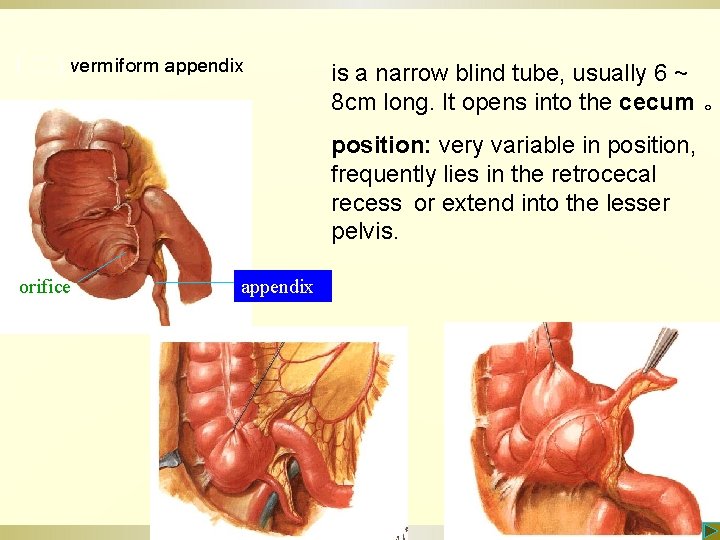 （二）vermiform appendix is a narrow blind tube, usually 6 ~ 8 cm long. It