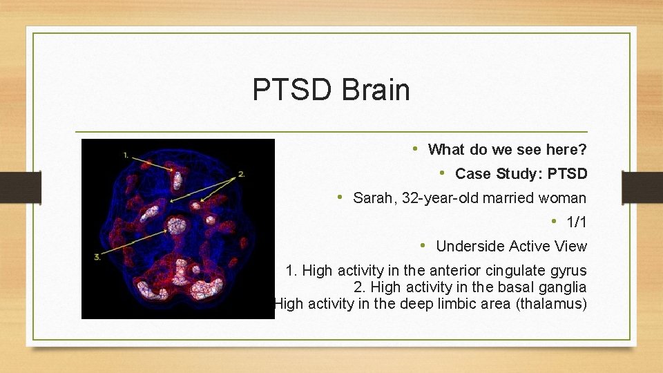 PTSD Brain • What do we see here? • Case Study: PTSD • Sarah,