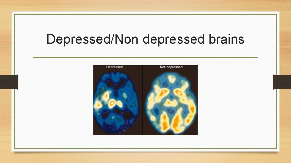 Depressed/Non depressed brains 