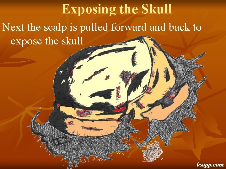 Exposing the Skull Next the scalp is pulled forward and back to expose the