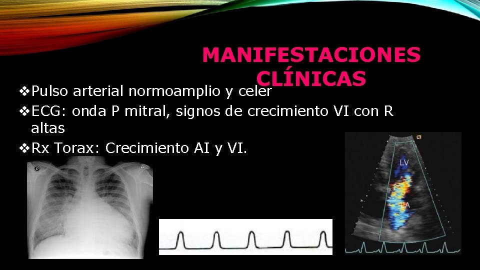 MANIFESTACIONES CLÍNICAS Pulso arterial normoamplio y celer ECG: onda P mitral, signos de crecimiento