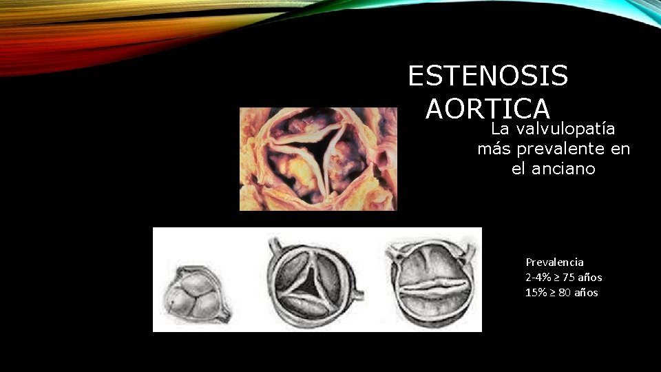 ESTENOSIS AORTICA La valvulopatía más prevalente en el anciano Prevalencia 2 -4% ≥ 75