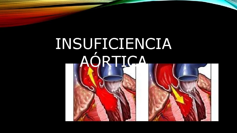 INSUFICIENCIA AÓRTICA 