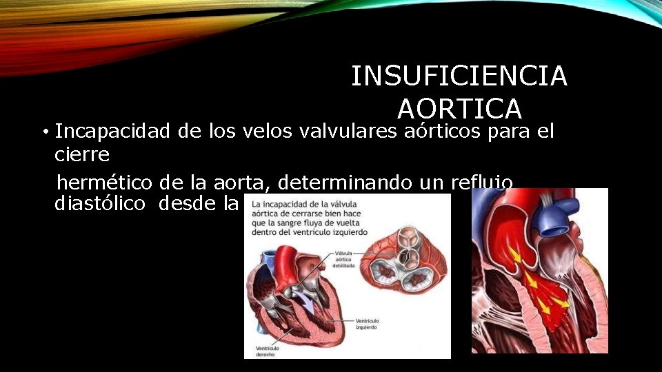 INSUFICIENCIA AORTICA • Incapacidad de los velos valvulares aórticos para el cierre hermético de
