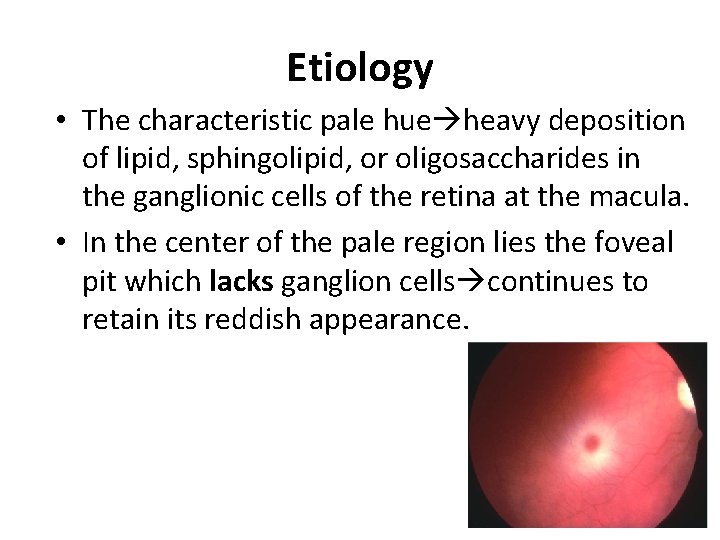 Etiology • The characteristic pale hue heavy deposition of lipid, sphingolipid, or oligosaccharides in