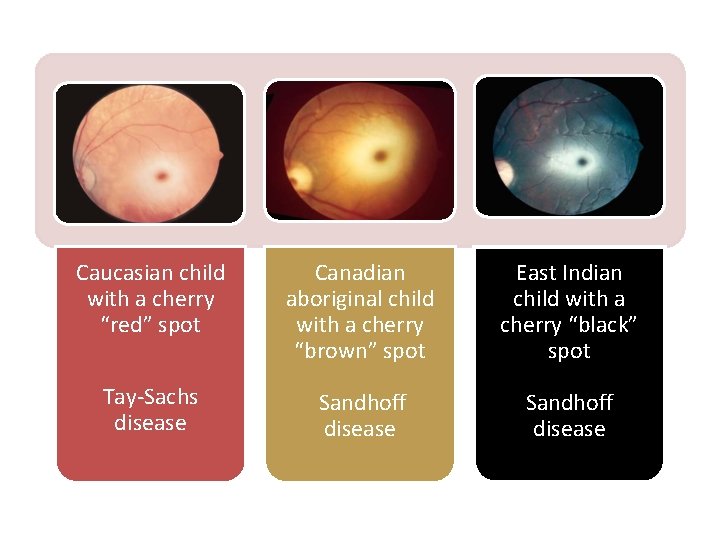 Caucasian child with a cherry “red” spot Canadian aboriginal child with a cherry “brown”