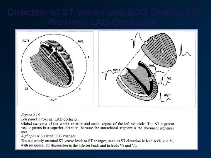 Direction of ST Vector and ECG Changes in Proximal LAD Occlusion 