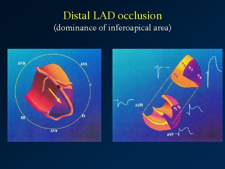 Distal LAD occlusion (dominance of inferoapical area) 