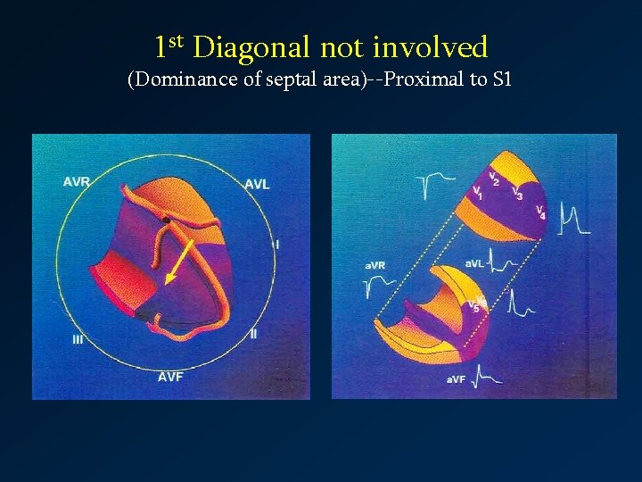 1 st Diagonal not involved (Dominance of septal area)--Proximal to S 1 