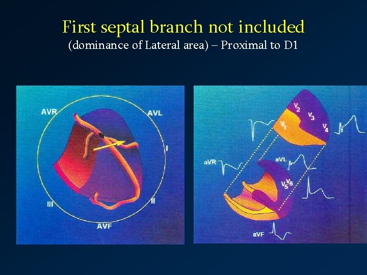 First septal branch not included (dominance of Lateral area) – Proximal to D 1