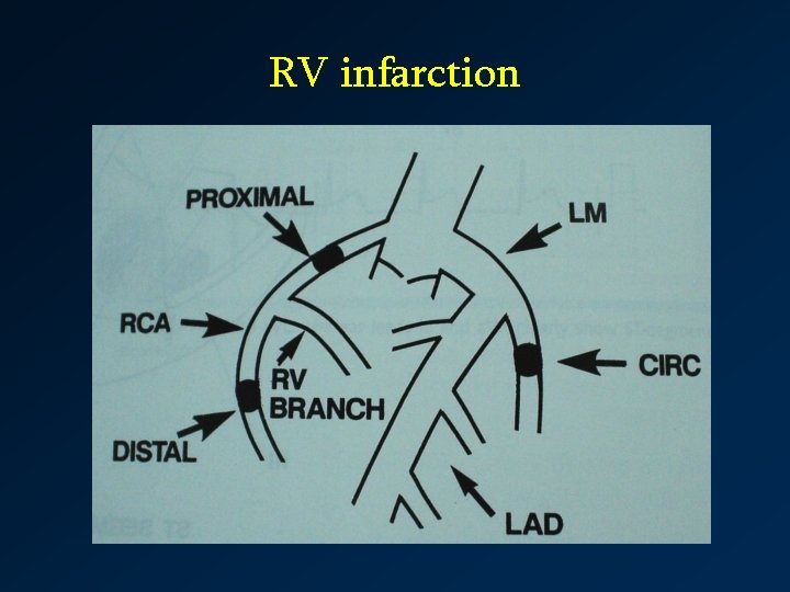 RV infarction 