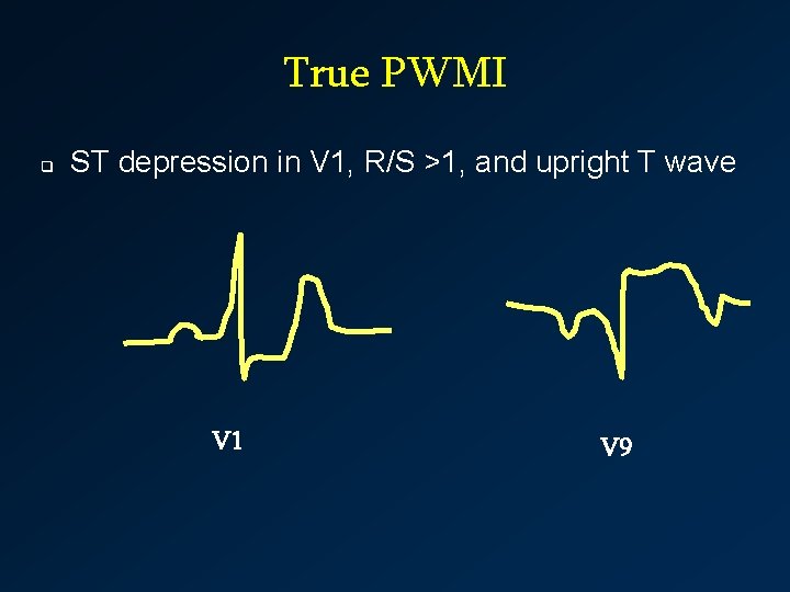 True PWMI q ST depression in V 1, R/S >1, and upright T wave
