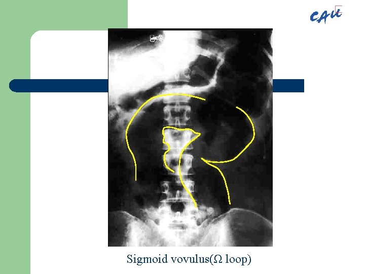 Sigmoid vovulus(Ω loop) 