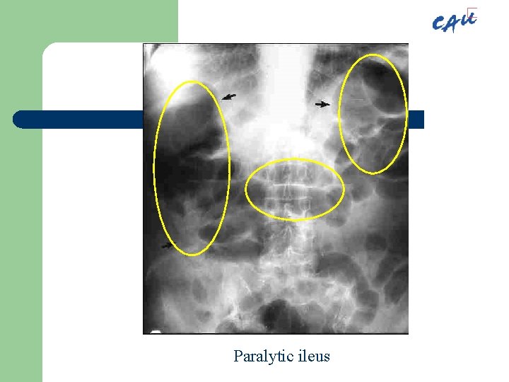 Paralytic ileus 