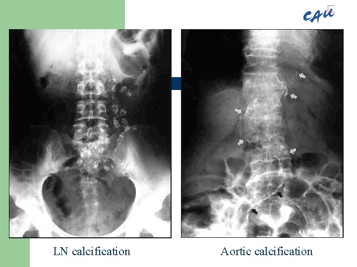 LN calcification Aortic calcification 