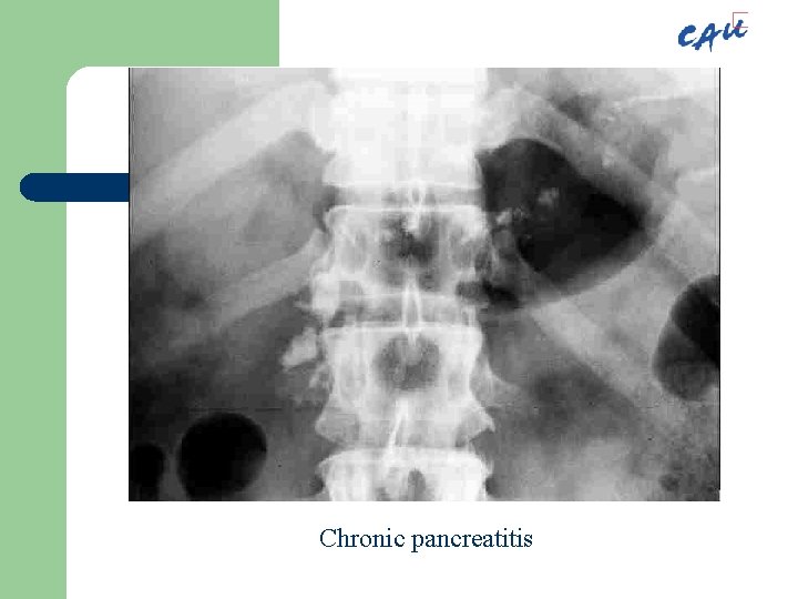 Chronic pancreatitis 