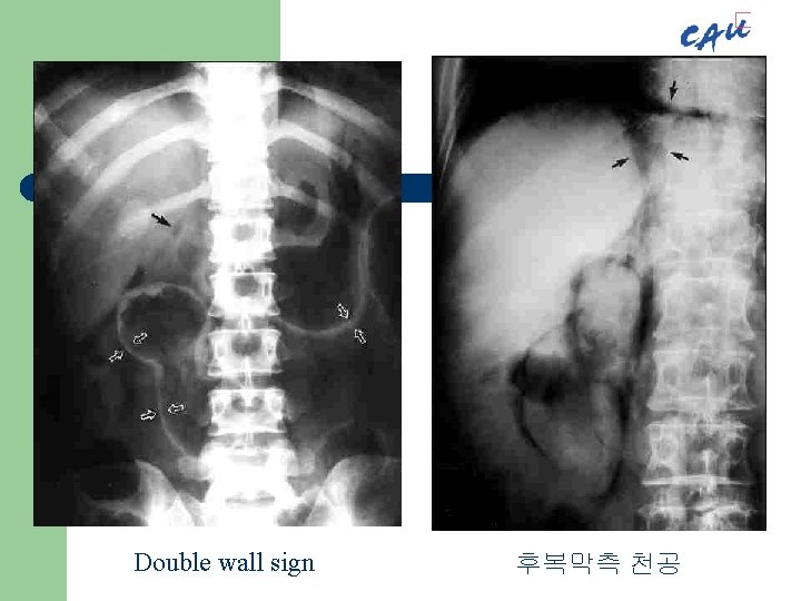 Double wall sign 후복막측 천공 