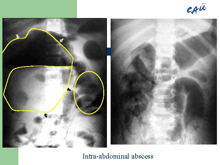 Intra-abdominal abscess 