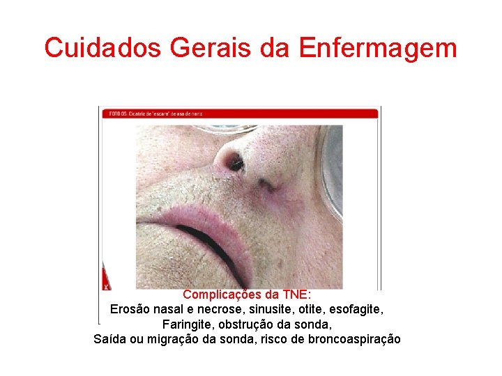 Cuidados Gerais da Enfermagem Complicações da TNE: Erosão nasal e necrose, sinusite, otite, esofagite,