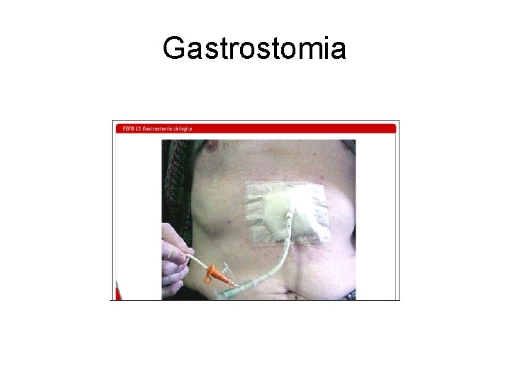 Gastrostomia 