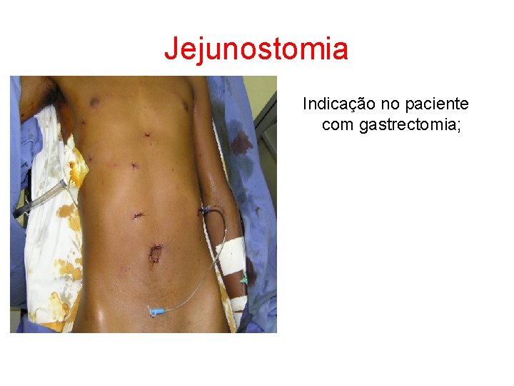Jejunostomia Indicação no paciente com gastrectomia; 
