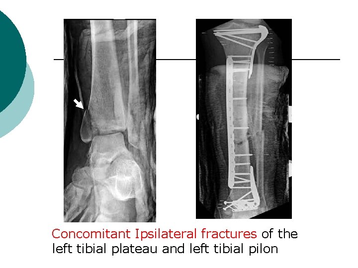 Concomitant Ipsilateral fractures of the left tibial plateau and left tibial pilon 