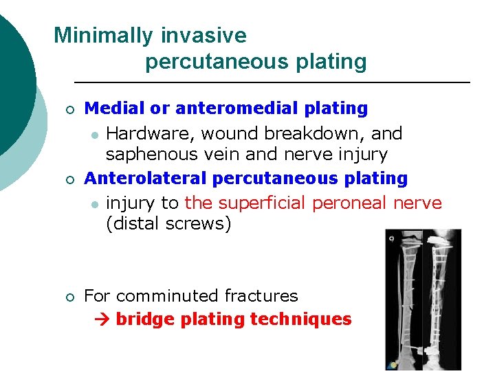 Minimally invasive percutaneous plating ¡ Medial or anteromedial plating ¡ Hardware, wound breakdown, and