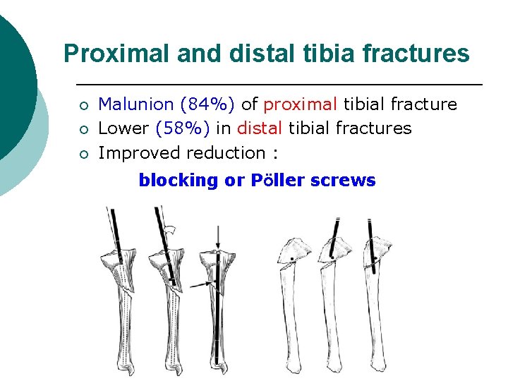 Proximal and distal tibia fractures ¡ ¡ ¡ Malunion (84%) of proximal tibial fracture