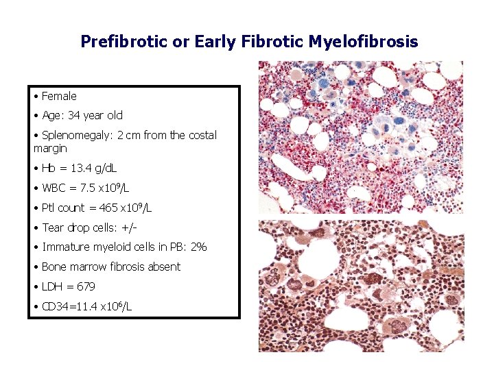 Prefibrotic or Early Fibrotic Myelofibrosis • Female • Age: 34 year old • Splenomegaly: