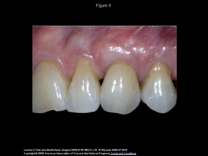 Figure 9 Journal of Oral and Maxillofacial Surgery 2009 6740 -48 DOI: (10. 1016/j.