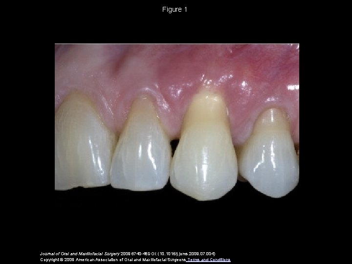 Figure 1 Journal of Oral and Maxillofacial Surgery 2009 6740 -48 DOI: (10. 1016/j.