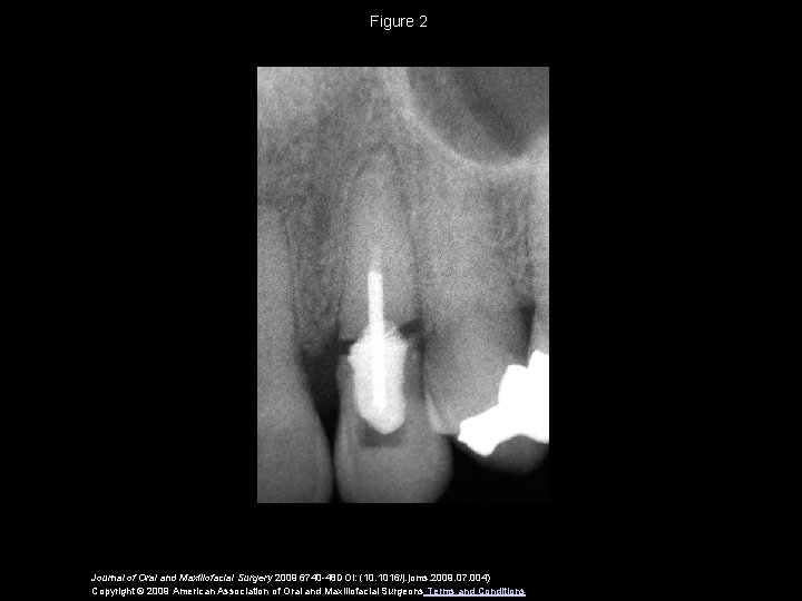 Figure 2 Journal of Oral and Maxillofacial Surgery 2009 6740 -48 DOI: (10. 1016/j.