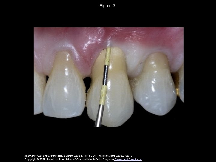 Figure 3 Journal of Oral and Maxillofacial Surgery 2009 6740 -48 DOI: (10. 1016/j.