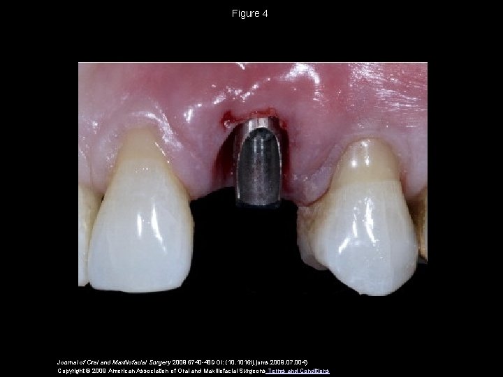 Figure 4 Journal of Oral and Maxillofacial Surgery 2009 6740 -48 DOI: (10. 1016/j.