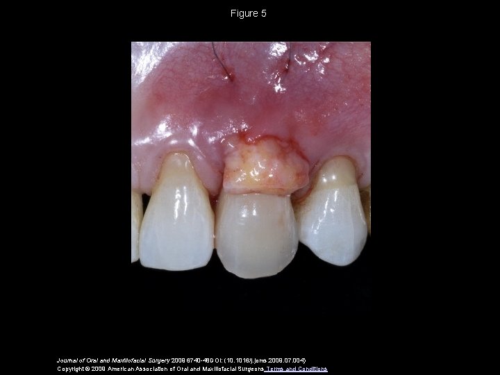 Figure 5 Journal of Oral and Maxillofacial Surgery 2009 6740 -48 DOI: (10. 1016/j.