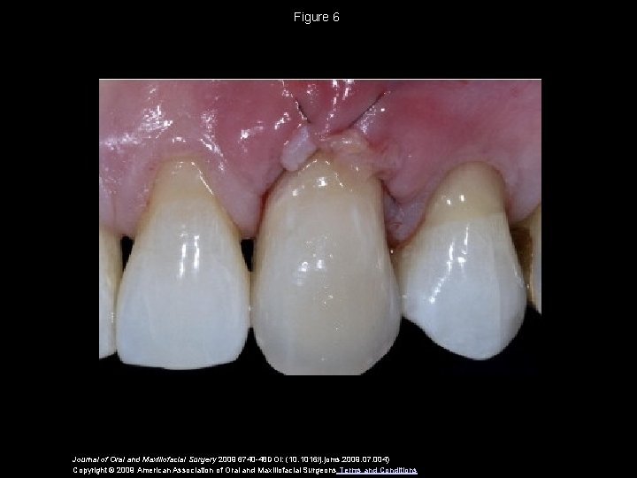 Figure 6 Journal of Oral and Maxillofacial Surgery 2009 6740 -48 DOI: (10. 1016/j.